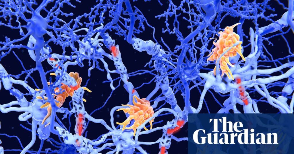Two new subtypes of MS found in ‘exciting’ breakthrough | Multiple sclerosis