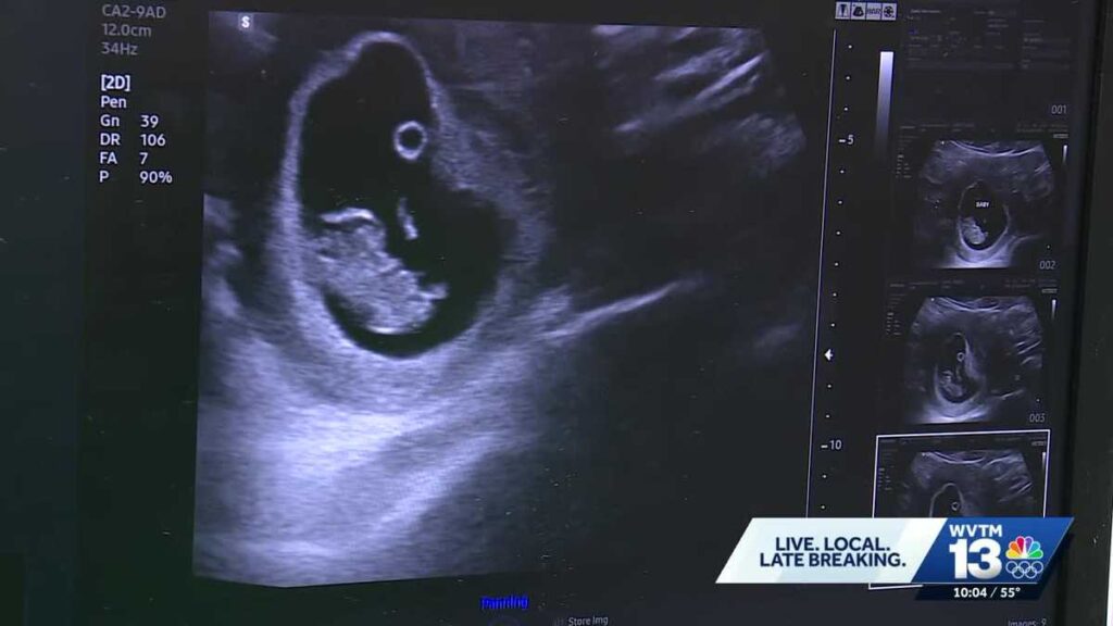 Alabama's robotic ultrasound plan raises concerns from OB-GYNs
